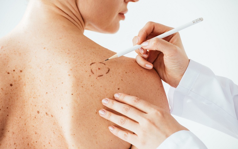 Melanoma Treatment