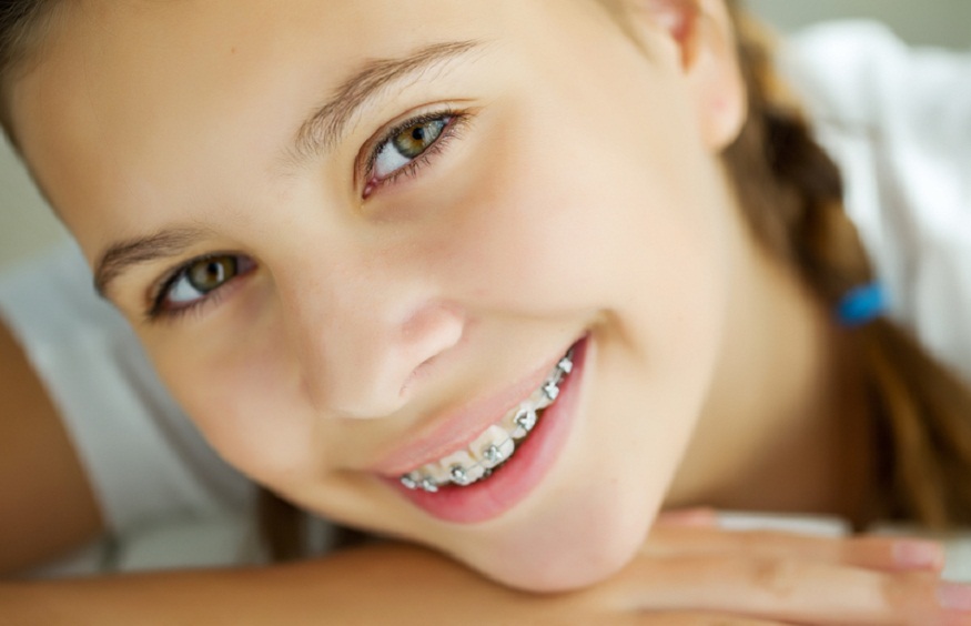 Braces A Guide to Comfort and Care