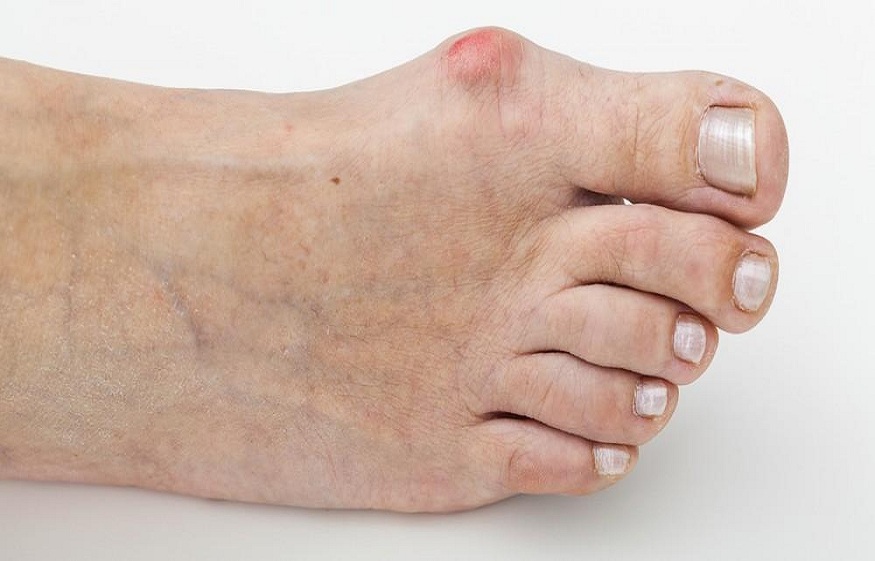 Manage Bunions