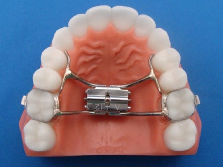 Power of Palatal Expanders