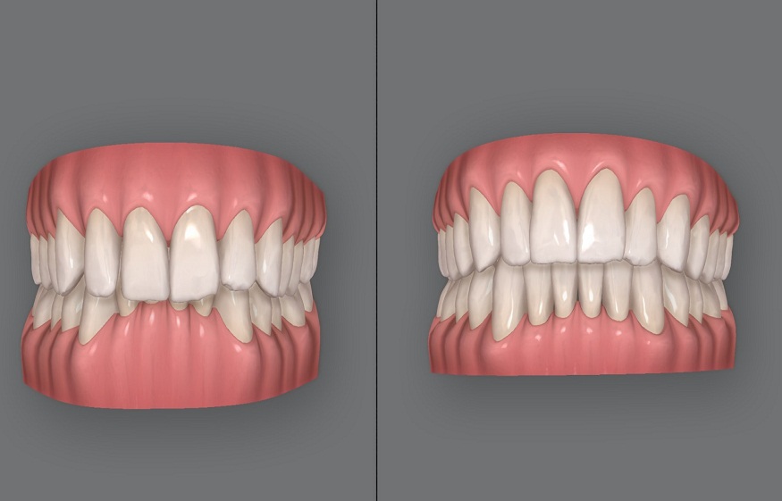 Correcting Overbite with Invisalign