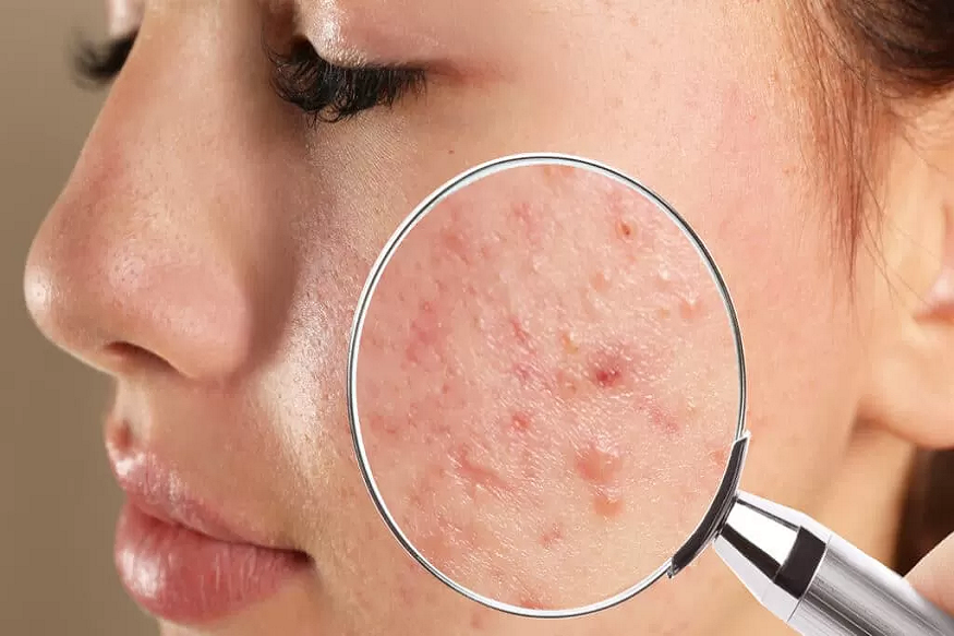 acne facial treatment in Singapore